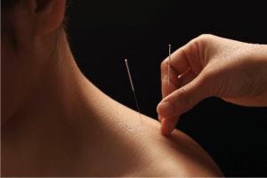 Bild von Akupunktur